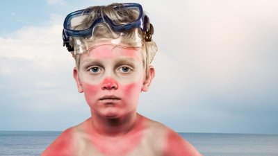Солнечный ожог у детей: что с этим делать?
